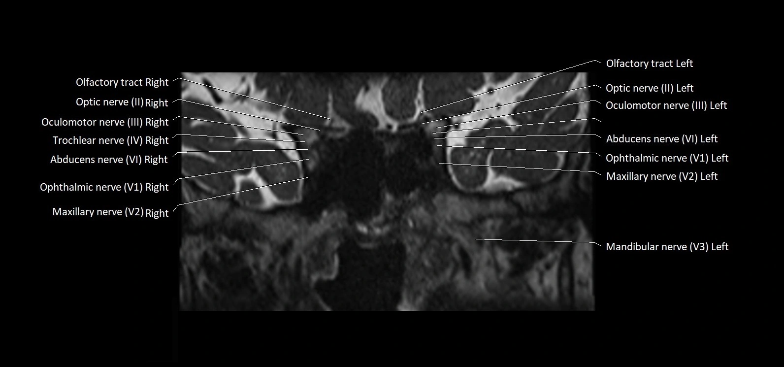 Cranial nerve cross sectional anatomy coronal 3T MRI image 21.webp